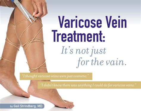 varicose veins treatment pdf